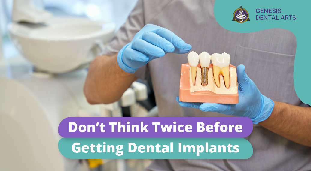 Don’t Think Twice Before Getting Dental Implants: Essential Facts You Need to Know