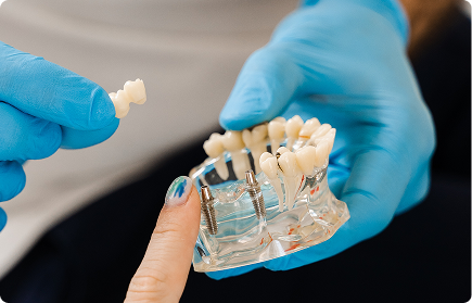 Dental Implants in South Pasadena