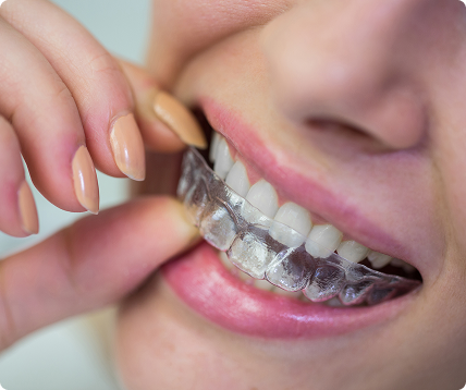 Invisalign for San Gabriel, CA