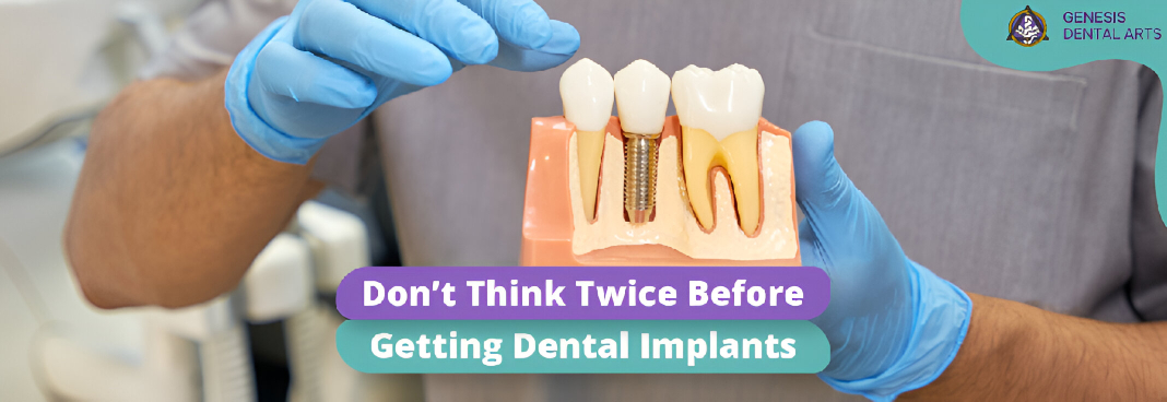 Don’t Think Twice Before Getting Dental Implants: Essential Facts You Need to Know