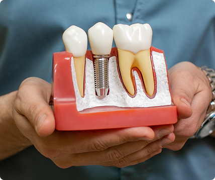 Dental Implants Near San Gabriel