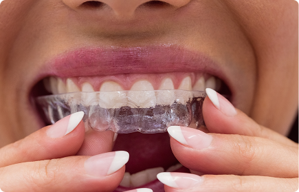 Invisalign in South Pasadena