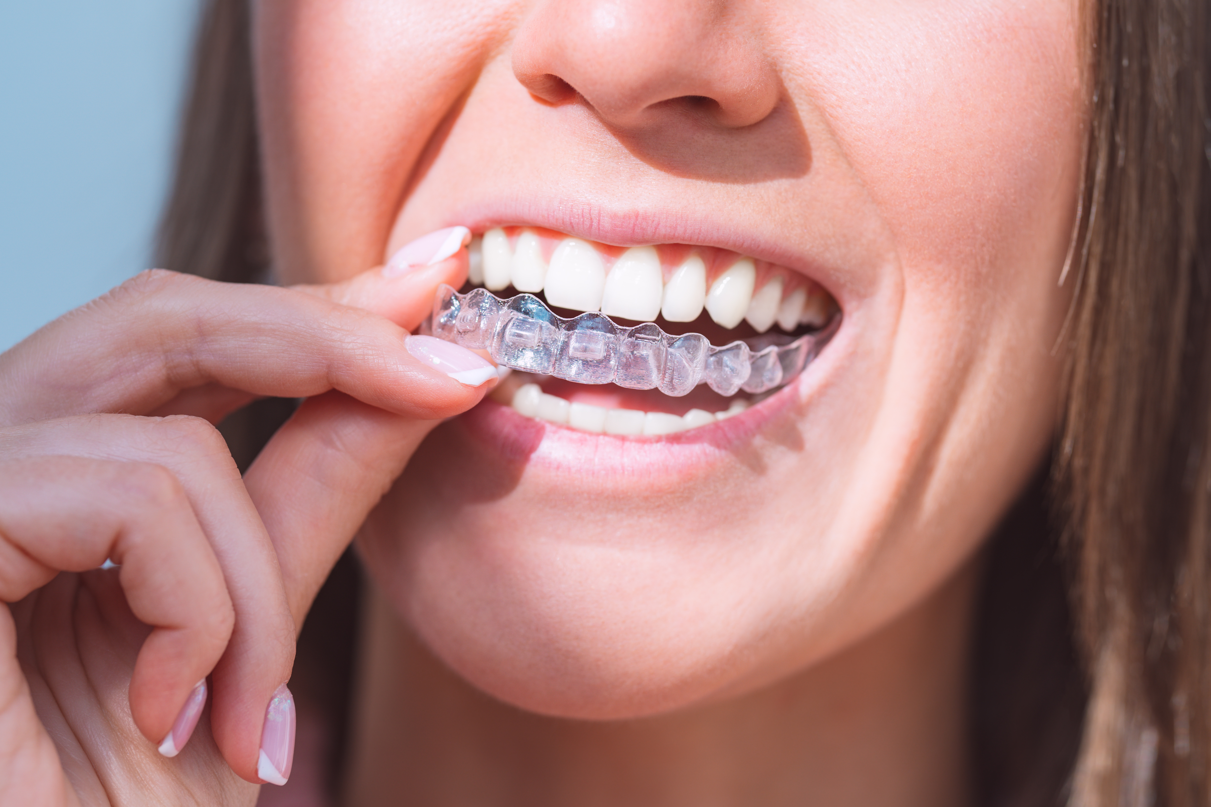 Invisalign near Alhambra, CA